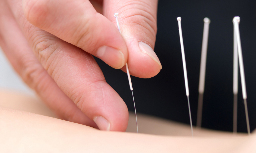 Acupuncture