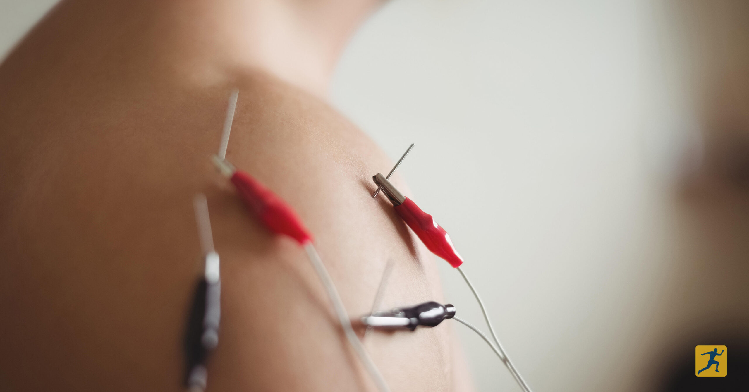 Dry Needling